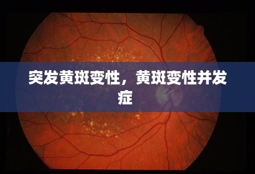 突发黄斑变性，黄斑变性并发症 