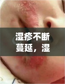 湿疹不断蔓延，湿疹一直蔓延 