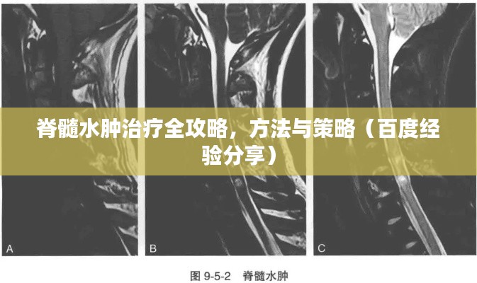 脊髓水肿治疗全攻略，方法与策略（百度经验分享）