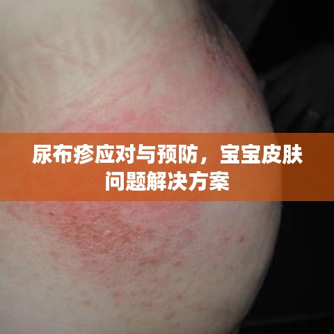 尿布疹应对与预防，宝宝皮肤问题解决方案