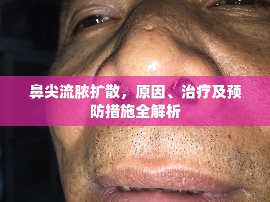 鼻尖流脓扩散，原因、治疗及预防措施全解析